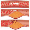 Oxidized cholesterol is responsible for deposition of plaque in arteries.