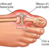 Because of High Uric acid in blood,crystal deposits in joints causing pain and inflammation.