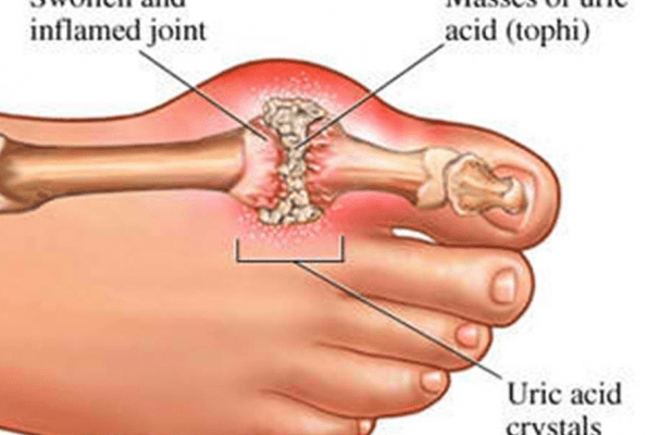 Because of High Uric acid in blood,crystal deposits in joints causing pain and inflammation.