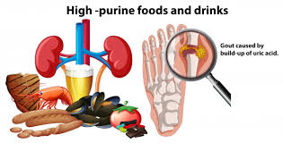 A High purine food is responsible for high Uric Acid.






 Edit with Elementor
Save draft
Preview
Publish



Add title
                                                                             Control High Uric Acid, Naturally                 
Every one of us wants a happy and balanced life, but do we all owe it? The answer to this question is certainly not. Because it is a herculean task to keep your entire body systems healthy and fit. Our body filters out uric acid, but if the level of uric acid is high it causes many diseases. Here are some checkpoints to Control high Uric Acid Naturally.
What is the reason for high uric acid level?
Purines are compounds, which normally produces in your body. It also presents in some food. When your body breaks down purine, it produces uric acid in the body. If you consume purine in excess it becomes difficult to get rid of excess Uric acid. This uric acid deposits in the form of crystals in your bones and in kidney and causing pain and inflammation.  To avoid excess purine you should take dried beans, Green pea, cauliflower, shellfish, mushrooms and some meats in limited manner. Low purine diet is very helpful in kidney and digestive problems.

Control your high Uric Acid Naturally
This image has an empty alt attribute; its file name is uric-acid-3.jpg
High purine food is responsible for high Uric Acid